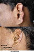 Before After Pictures,Cosmetic surgery,Delhi,ear reconstruction